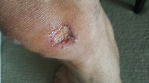 Got all of the gauze off the growing scab.